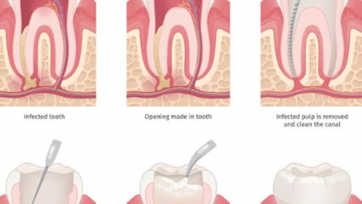 Các câu hỏi thường gặp về chữa tủy răng?