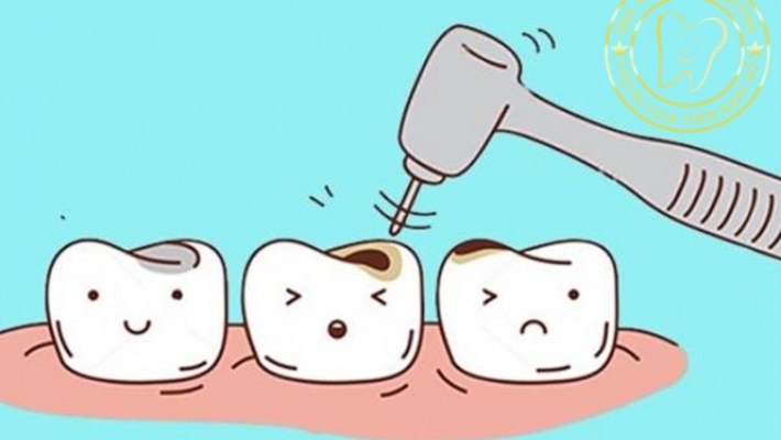 Bé bị sâu răng lan nhanh – giải pháp điều trị an toàn