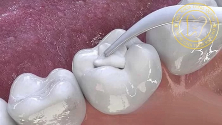 Răng sữa hư có nên trám không? Khi nào cần điều trị?