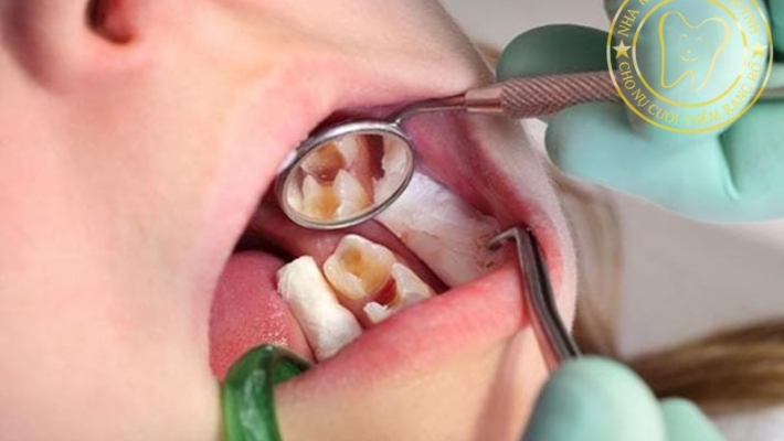 Khám răng tổng quát định kỳ: Bí quyết giữ răng chắc khoẻ