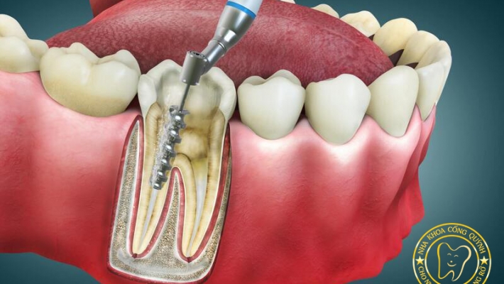 Chữa tủy răng sau