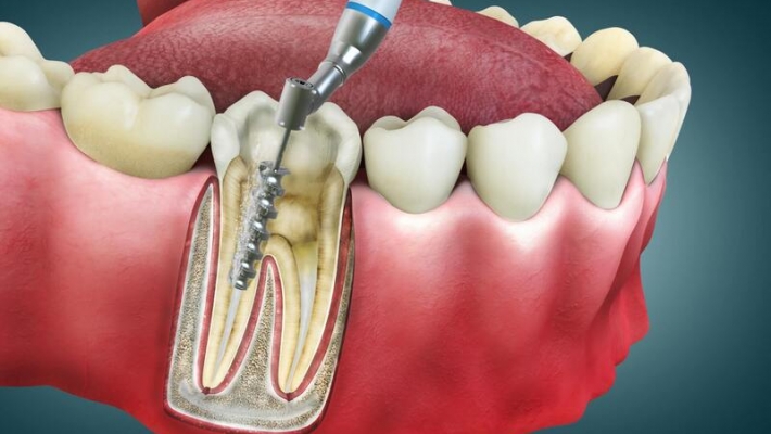 Chữa tủy răng sau