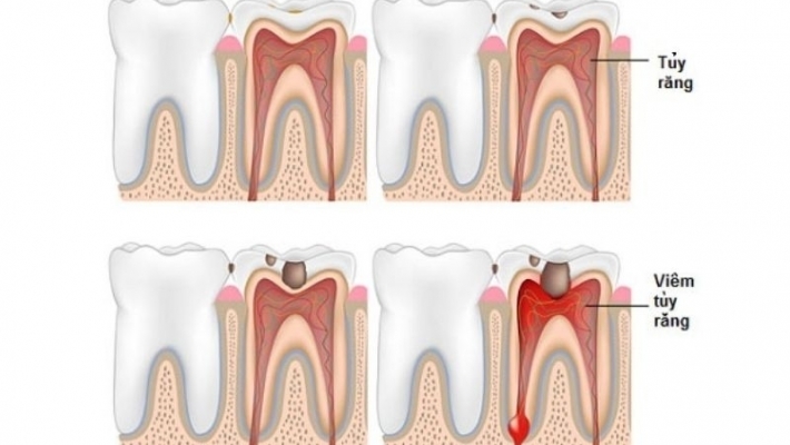 Chữa tủy răng có đau không? Quy trình điều trị tại Nha Khoa Cống Quỳnh