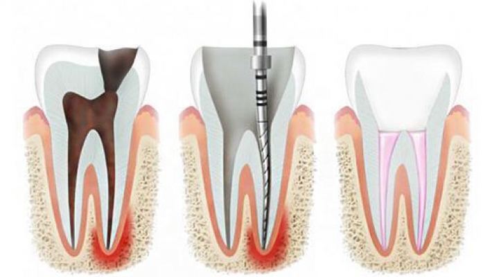 Chữa tủy răng trước