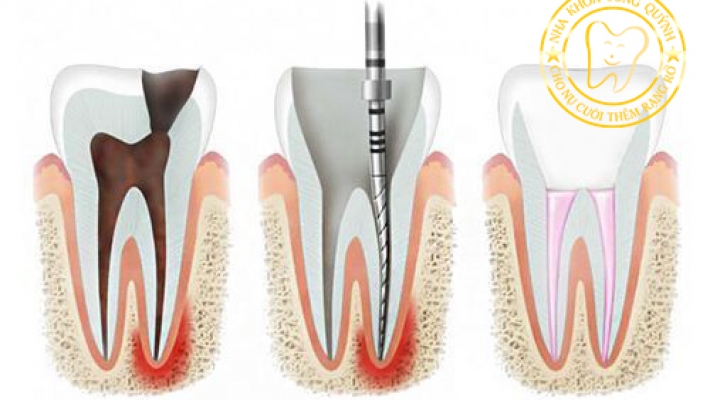 Chữa tủy răng trước