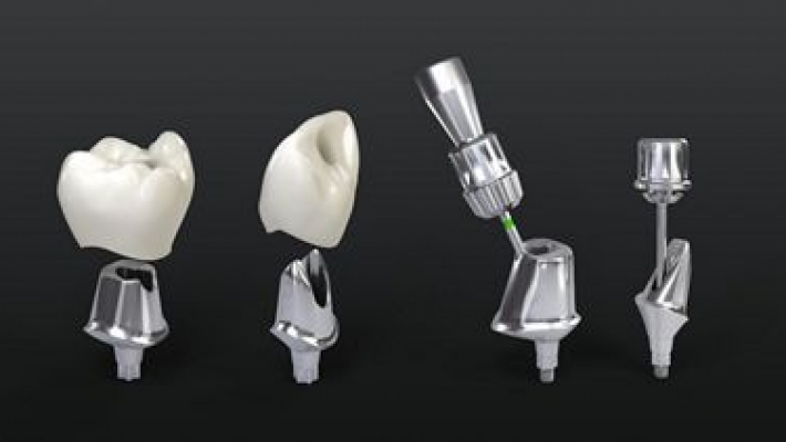 Implant Hahn – Nobel Biocare – Straumann: Nên chọn dòng nào phù hợp?