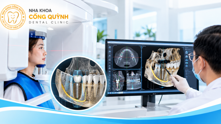 Vai trò của chụp CT Cone Beam trong kế hoạch Implant