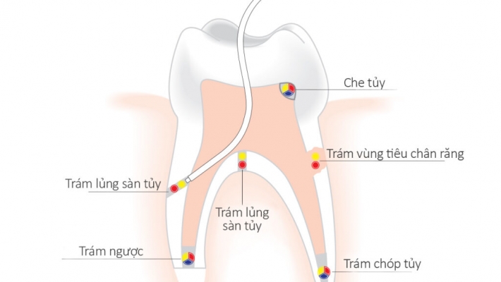 Tiểu phẩu cắt chóp/ trám ngược