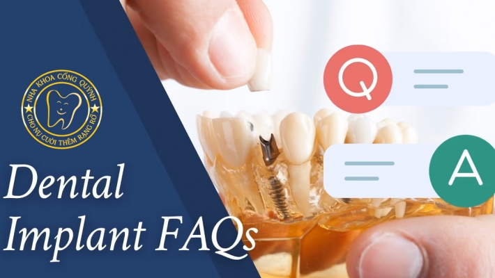 Các câu hỏi thường gặp về Cắm ghép Implant ?
