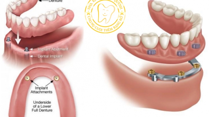 Phục hình tháo lắp
