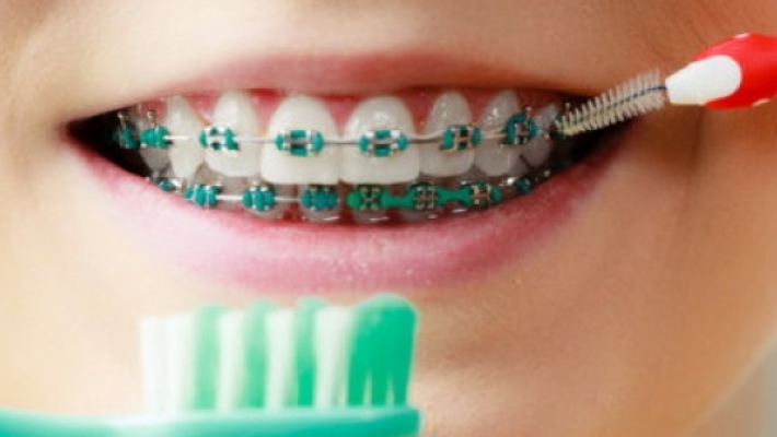 Hướng dẫn khi niềng răng