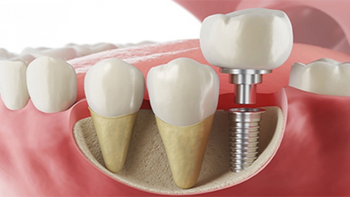 Răng sứ trên Implant (Zirconia CAD/CAM)