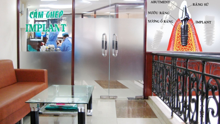 Cắm ghép Implant tặng quà tri ân