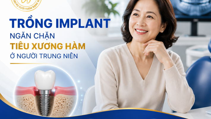 Implant có giúp ngăn chặn tiêu xương hàm ở người trung niên
