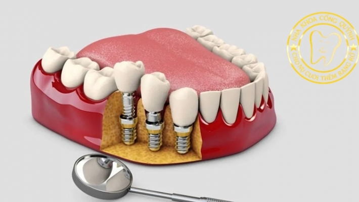 Tái khám & bảo dưỡng Implant định kỳ – Bí quyết duy trì kết quả lâu dài