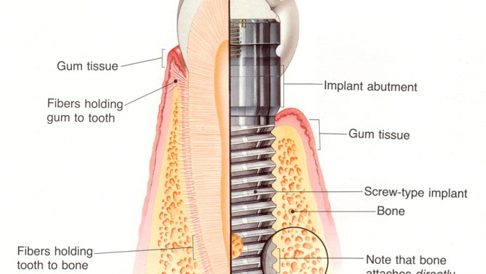Tích hợp xương là gì và tại sao quyết định thành công của Implant?