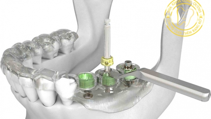 Cấy ghép Implant bằng máng phẫu thuật – Công nghệ hiện đại, an toàn tuyệt đối