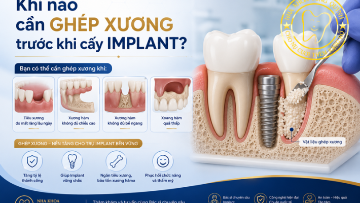 Khi nào cần ghép xương trước khi cấy Implant
