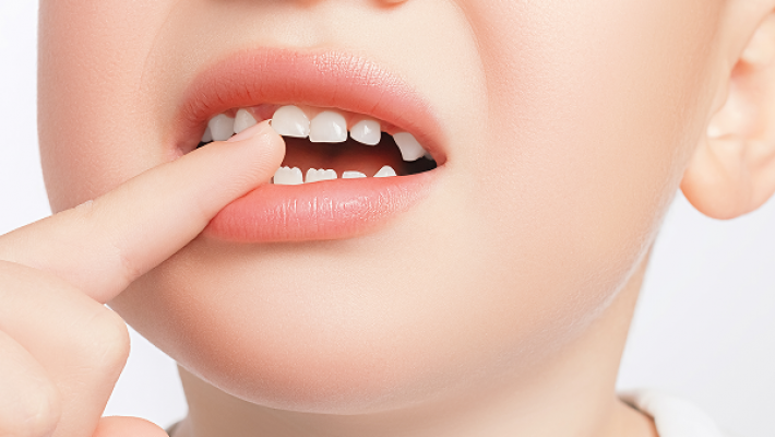 Nhổ răng trước