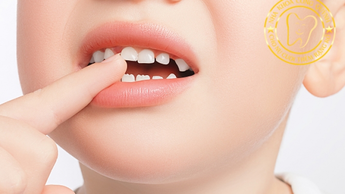 Nhổ răng trước