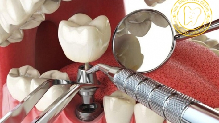 Khoảng trống mất răng ảnh hưởng đến khớp cắn ra sao