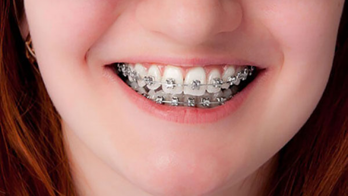 Mắc cài kim loại