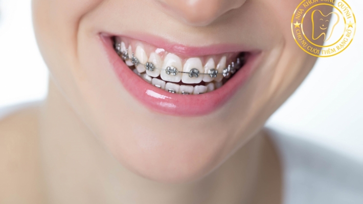 Lịch trình thay đổi khuôn mặt sau khi niềng răng