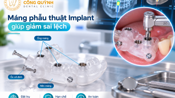 Máng phẫu thuật Implant giúp giảm sai lệch như thế nào