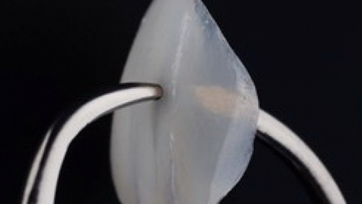 MẶT DÁN SỨ ULTRATHIN VENEER