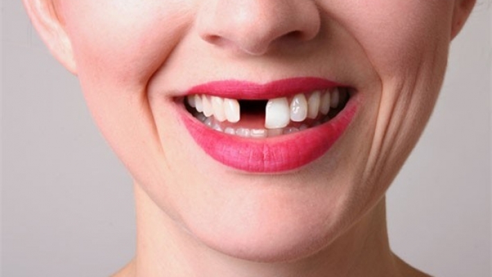 Mất răng cửa có nên trồng Implant ngay để giữ thẩm mỹ