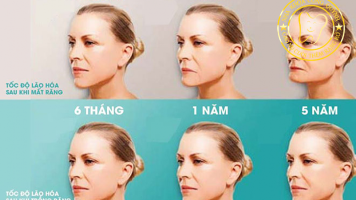 Những dấu hiệu cho thấy xương hàm đang tiêu dần sau mất răng