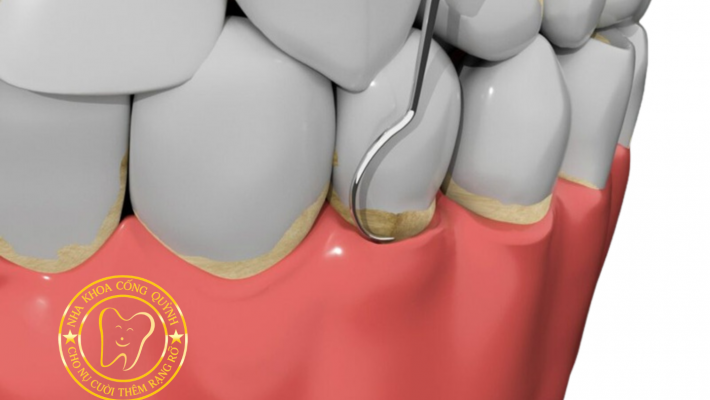 Nạo túi, xử lý bề mặt gốc răng