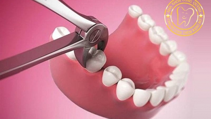 Nhổ răng sau Quận 1 tại Nha Khoa Cống Quỳnh – Nhổ răng hàm an toàn