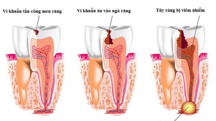 Chữa tủy trám MTA