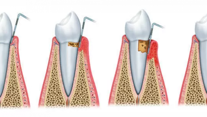 Điều trị nha chu viêm