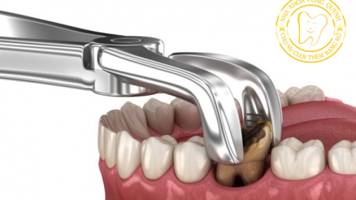 Nhổ răng tiểu phẩu tại Nha Khoa Cống Quỳnh