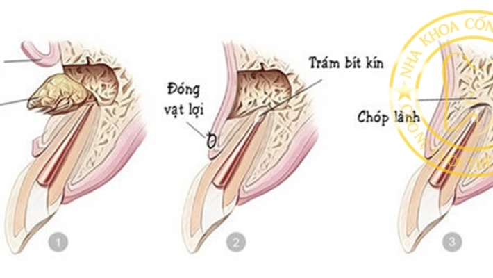 Tiểu phẫu cắt chóp trám ngược Quận 1 tại Nha Khoa Cống Quỳnh