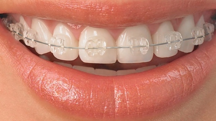 Niềng răng mắc cài sứ tại Quận 1 TP.HCM – Giải pháp chỉnh nha thẩm mỹ, kín đáo