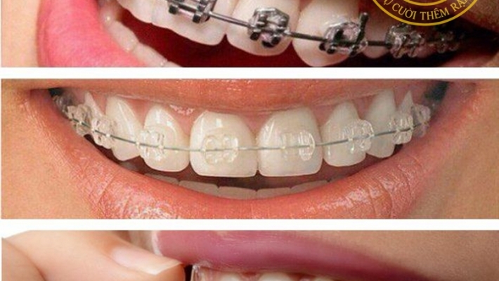 Niềng răng tại TP.HCM: Bảng giá mới nhất và quy trình tại Nha Khoa Cống Quỳnh