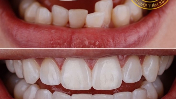 Các câu hỏi thường gặp về Niềng răng chỉnh nha?