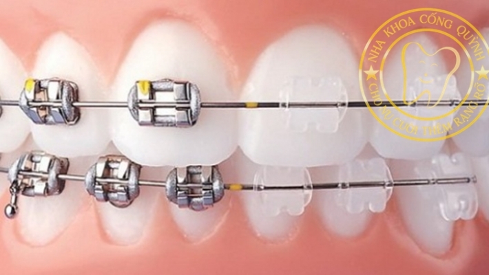 Niềng răng mắc cài kim loại: Ưu điểm, quy trình và bảng giá chi tiết