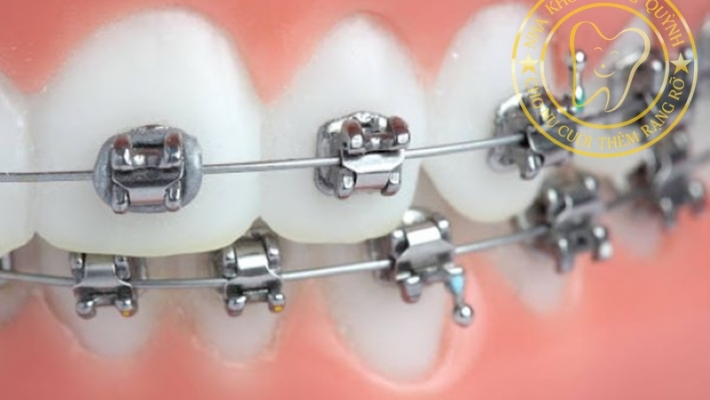 Niềng răng - Chỉnh nha Mắc cài