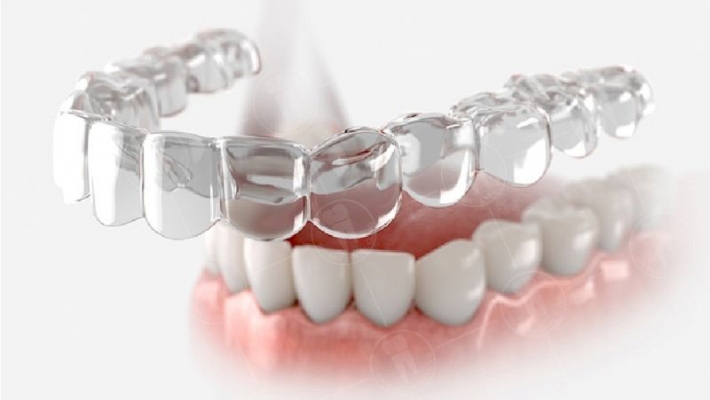 Chỉnh nha vô hình