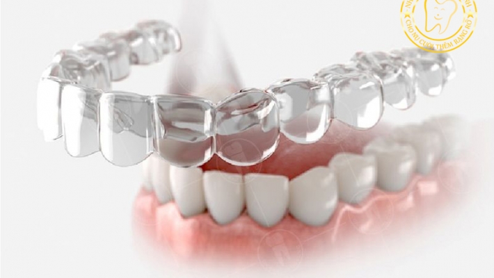 Niềng răng trong suốt Invisalign: Có phù hợp với người trưởng thành?