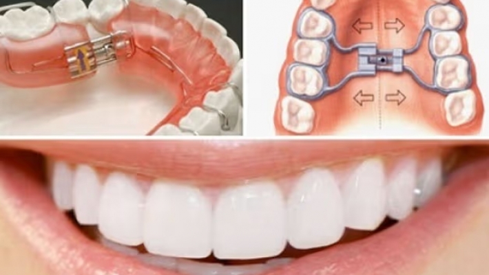 Niềng răng khí cụ tháo lắp tại Q1