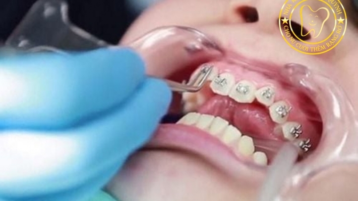 Các lỗi hay gặp khi niềng răng và cách tránh