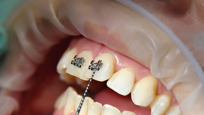 Niềng răng mắc cài kim loại tại trung tâm Q1