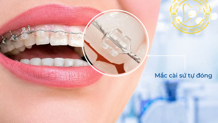 Niềng răng mắc cài tự đóng tại Quận 1