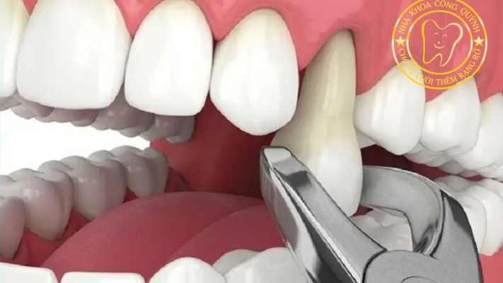Nhổ răng trước tại Quận 1 - Nhổ răng cửa không đau