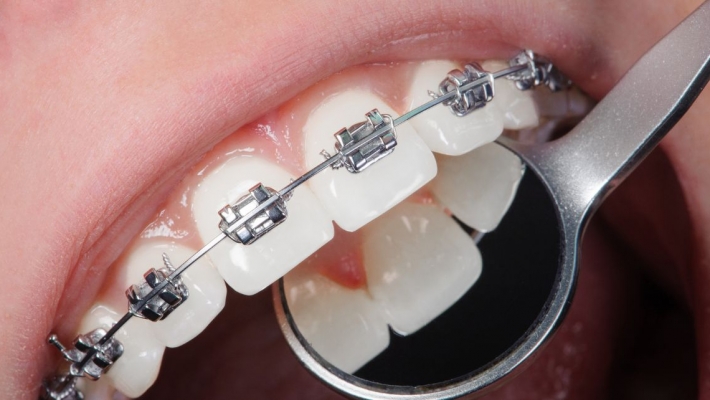 Mắc cài tự đóng